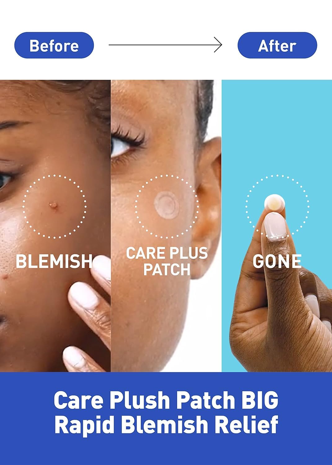 Korea Skincare Hydrocolloid Acne Pimple Blemishes Skin Trouble Spot Patch for Healing and Protecting 102 count 2size